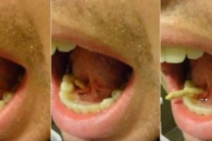 Ajaib, Ada Batu Muncul Di Dalam Mulut Pria Asal AS Ini